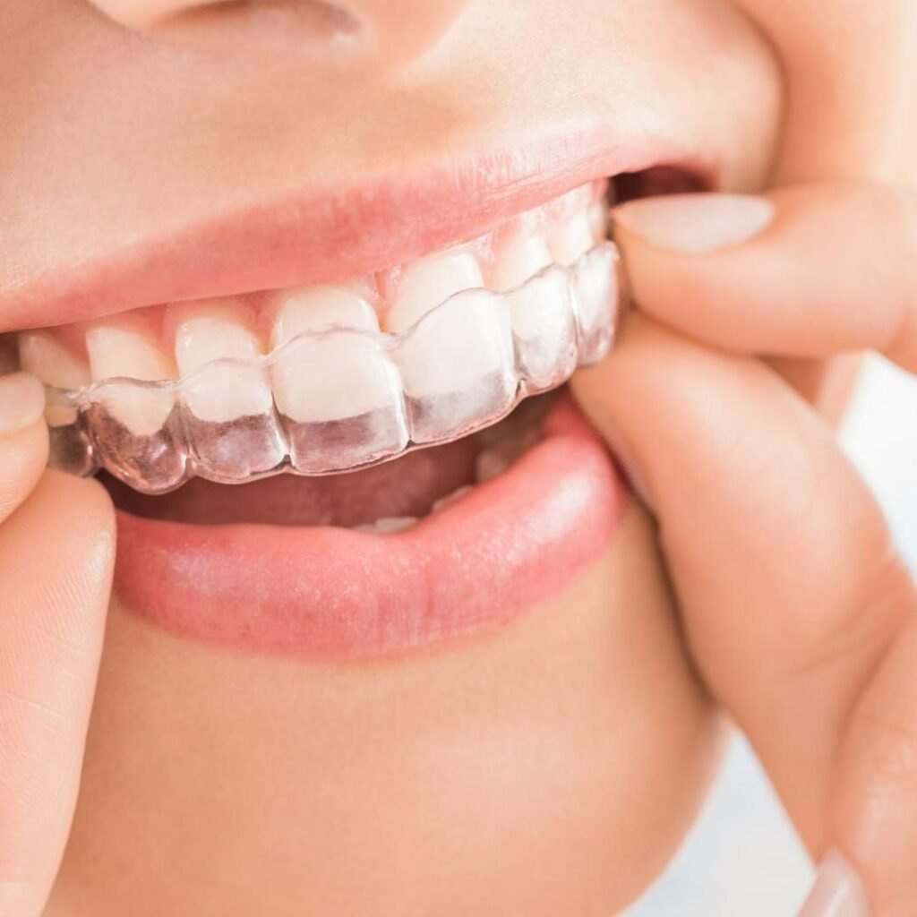 Clear Aligners – Trishool Dental Hospital