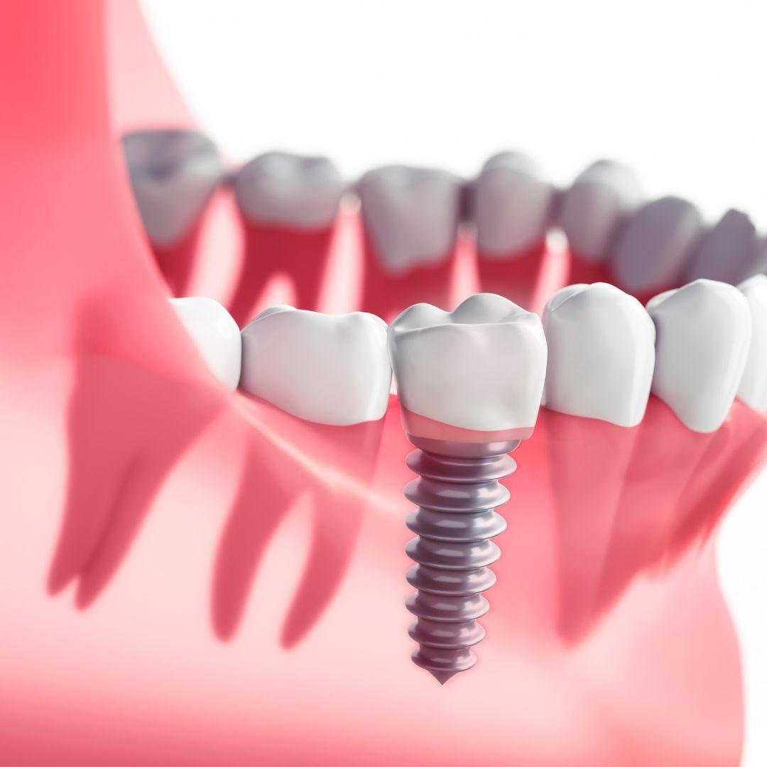 Dental Implants