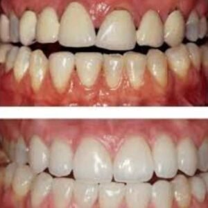 Gum Treatment